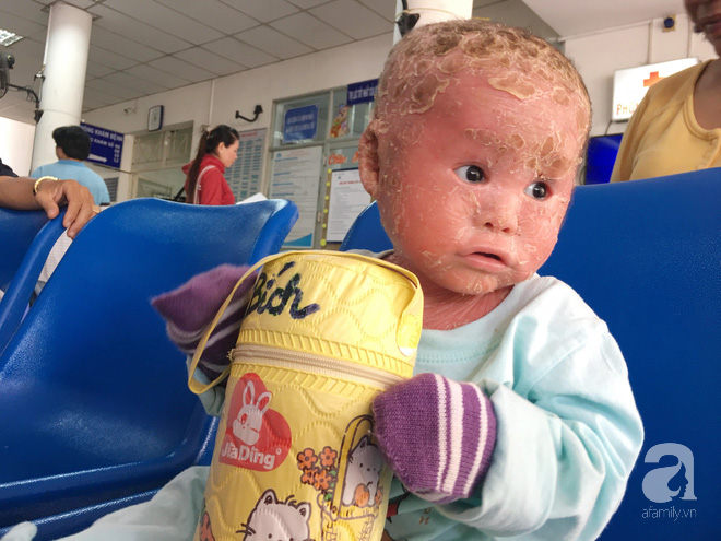 Ca sĩ Lam Trường đến thăm bé Bích - em bé bị vẩy ngứa da trăn trước khi bé nhập viện điều trị - Ảnh 2. Ca sĩ Lam Trường đến thăm bé Bích - em bé bị vẩy ngứa da trăn trước khi bé nhập viện điều trị 2