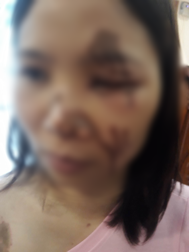 Hà Nội: Nữ chủ tiệm thuốc tố bị bác sỹ tạt axit đến bỏng nặng khi gạ gẫm không thành 1