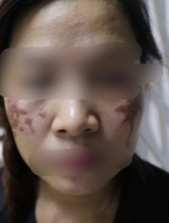 Hai má của người phụ nữ ở Hà Nội bị loang lổ vết thâm đen sau khi trị nám bằng axit tại spa 2