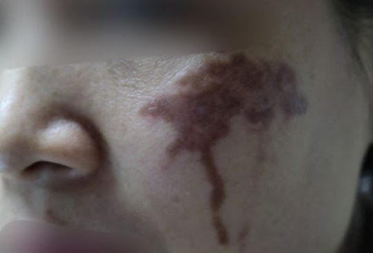 Hai má của người phụ nữ ở Hà Nội bị loang lổ vết thâm đen sau khi trị nám bằng axit tại spa 1