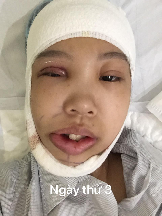 Bị bạn bè trêu chọc vì teo nửa bên mặt, cô gái Hà Nội lột xác sau phẫu thuật thẩm mỹ 3