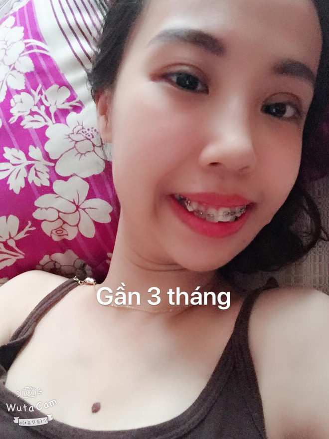 Bị bạn bè trêu chọc vì teo nửa bên mặt, cô gái Hà Nội lột xác sau phẫu thuật thẩm mỹ - Ảnh 6. Bị bạn bè trêu chọc vì teo nửa bên mặt, cô gái Hà Nội lột xác sau phẫu thuật thẩm mỹ 11