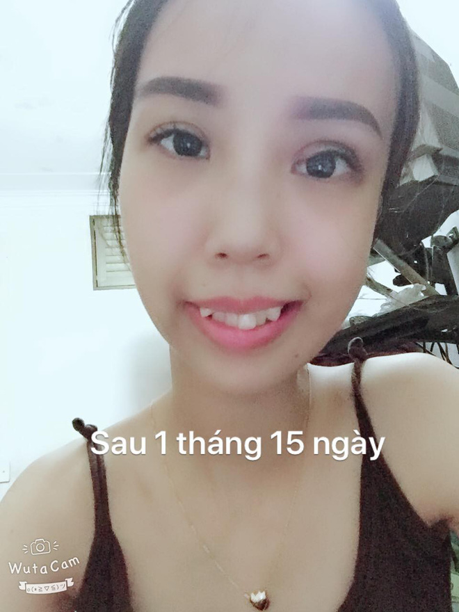 Bị bạn bè trêu chọc vì teo nửa bên mặt, cô gái Hà Nội lột xác sau phẫu thuật thẩm mỹ 9