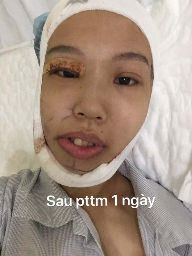 Bị bạn bè trêu chọc vì teo nửa bên mặt, cô gái Hà Nội lột xác sau phẫu thuật thẩm mỹ 5