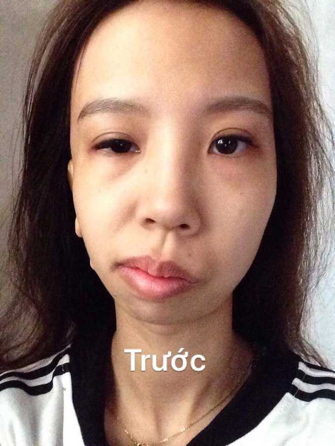 Bị bạn bè trêu chọc vì teo nửa bên mặt, cô gái Hà Nội lột xác sau phẫu thuật thẩm mỹ - Ảnh 2. Bị bạn bè trêu chọc vì teo nửa bên mặt, cô gái Hà Nội lột xác sau phẫu thuật thẩm mỹ 2