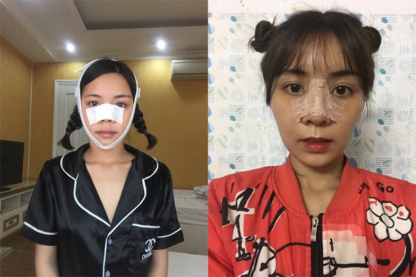 Cuộc sống của những cô gái từng bị chê là 'khỉ', 'vượn', 'Thị Nở' sau khi lột xác ngoạn mục nhờ dao kéo 17 Cuộc sống của những cô gái từng bị chê là 'khỉ', 'vượn', 'Thị Nở' sau khi lột xác ngoạn mục nhờ dao kéo 17