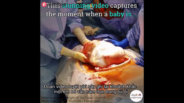 Cận cảnh em bé chào đời trong một ca sinh mổ hiếm gặp chỉ xảy ra với xác xuất 1/80.000 ca