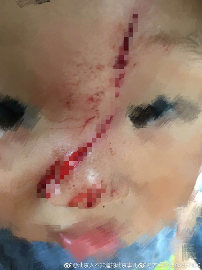 Trung Quốc: Em bé 1 tuổi đang chơi ngoài công viên thì bị flycam sà xuống chém trúng mặt 3