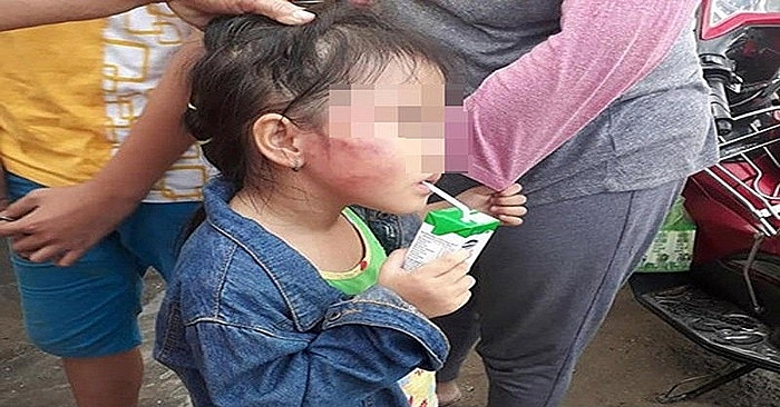 Vụ bạo hành trẻ ở Bình Chánh: Bé gái 5 tuổi có bị gãy xương hàm? 1