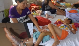 Bé trai 9 tuổi bị rắn lục đuôi đỏ cắn