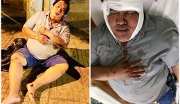 Danh hài Hoàng Mập bị tai nạn nghiêm trọng giữa đêm, lái xe đã bỏ trốn