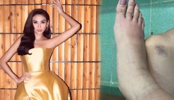 Võ Hoàng Yến tiết lộ tình trạng bất ổn của đôi chân 'bạc tỷ' khiến ai nấy xót xa