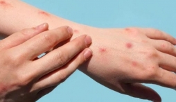 NÓNG: Hướng dẫn chẩn đoán, quy trình điều trị bệnh đậu mùa khỉ từ Bộ Y tế 