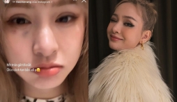 Hiền Hồ gây chú ý với vết bầm lớn trên mặt, netizen thở dài ngao ngán