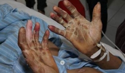 Hoại tử tay chân do ăn tiết canh dịp Tết