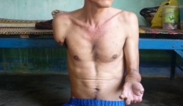 Người đàn ông bị rụng dần chân tay ở Khánh Hòa