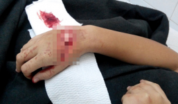 Một nữ sinh lớp 8 bị chém đứt gân tay