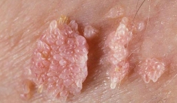 Mắc sùi mào gà vì nghĩ ô sin 'an toàn'