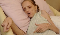 Hình ảnh đáng sợ cơ thể người phụ nữ uống 40 chai rượu mỗi ngày