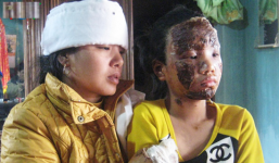 Vụ nổ quà sinh nhật kinh hoàng qua lời kể của nạn nhân