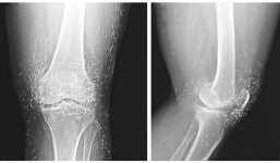 Phát hiện hàng trăm chiếc kim...trong đầu gối sau khi châm cứu
