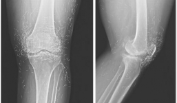 Phát hiện 'mỏ' vàng trong đầu gối cụ bà 65