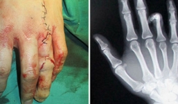 Ghép ngón chân vào bàn tay để... dễ xin việc