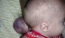 Bé gái có phần não nằm ngoài hộp sọ vẫn sống khỏe mạnh