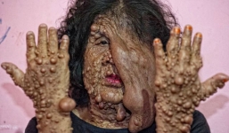 Người phụ nữ 'mặt quỷ' bị chồng đuổi ra khỏi nhà