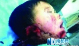 Bé 6 tuổi bị cô ruột cắt tai do mâu thuẫn gia đình