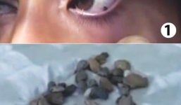 Bé gái 12 tuổi khóc ra đá khiến y học bó tay