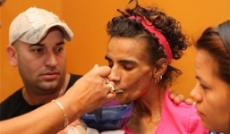 Thiếu nữ xinh đẹp biến dạng thành 'dị nhân' sau phẫu thuật nâng ngực