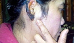 Chị chồng cắn nát tai em dâu