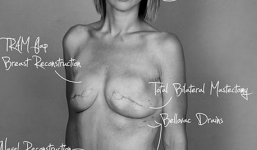 Bị “ném đá” vì phơi bày cơ thể sau phẫu thuật ung thư vú lên Facebook