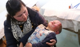 Thả pháo vào ống cống, bé 3 tuổi bị bỏng toàn thân