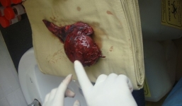 Rùng mình khối u khổng lồ trong phổi bệnh nhân hút thuốc lá