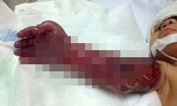 Bé gái sơ sinh thiếu tháng bị hoại tử cả cánh tay