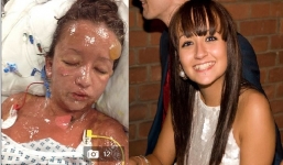 Thiếu nữ xinh đẹp hóa “quái vật” do dị ứng thuốc