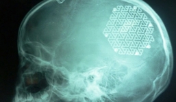 Lắp hộp sọ bằng kim loại cho bé gái 9 tuổi ở Quảng Bình