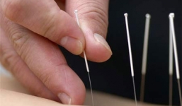 Những ai không nên châm cứu?