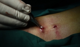 Thầy lang rởm nhét 42 viên ngọc vào người bệnh nhân để chữa đau lưng