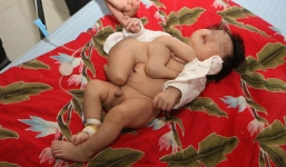 Xót xa em bé 2 tháng tuổi có 5 chân