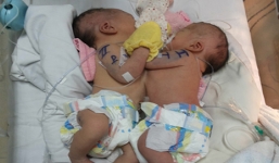Mổ tách rời, tái tạo bộ phận sinh dục cho 2 bé song sinh dính liền ngực