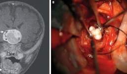 Răng mọc trong khối u não của bé trai 4 tháng tuổi