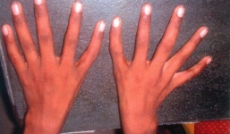 Cậu bé 10 tuổi có đôi bàn tay các ngón dài bằng nhau