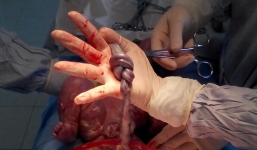 Hy hữu, thai nhi quấn 2 vòng dây rốn vẫn sống sót