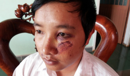 Truy bắt hai kẻ đánh thầy giáo bất tỉnh giữa đường