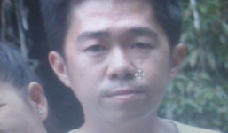 Chủ quán cà phê bị người tình tạt axit vào cơ thể trần trụi