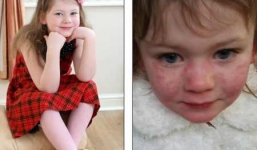 Bé gái 5 tuổi mắc bệnh lạ: Ăn kem sẽ chết