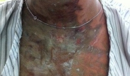 Bị khoét mắt, cắt tai, mũi vì tạt axit thiếu nữ